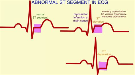 abnormal ekg results|abnormal ekg results before surgery.